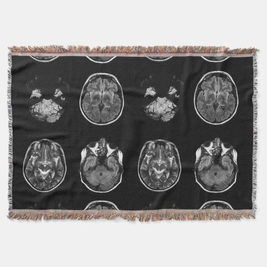 MRT des Gehirns Decke (Vorderseite)