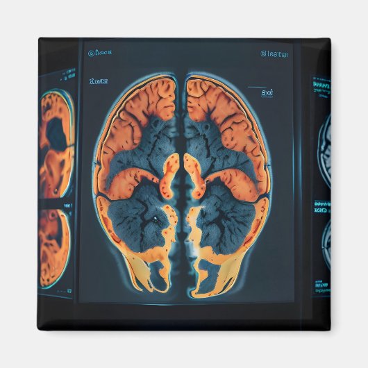 MRT-Gehirnuntersuchung Magnet (Vorne)