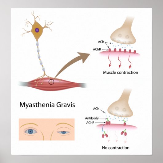 Myasthenie Gravis eye Poster (Vorne)