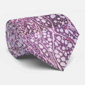 Nackenkarzinom mit adenoidem zystischem Karzinom Krawatte (Gerollt)