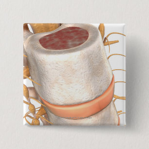 Nah oben von einem invertebral Disc im Dorn Button