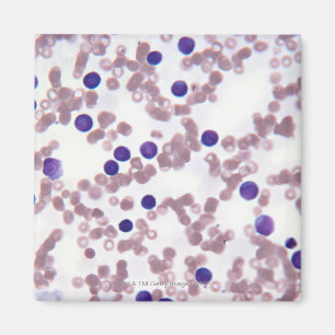 Neoplastische Lymphozyte-Zellen Magnet