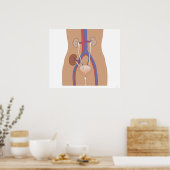 Nierentransplantation Poster (Küche)