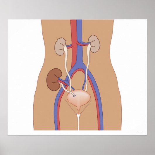 Nierentransplantation Poster (Vorne)