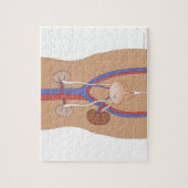 Nierentransplantation Puzzle (Vertikal)