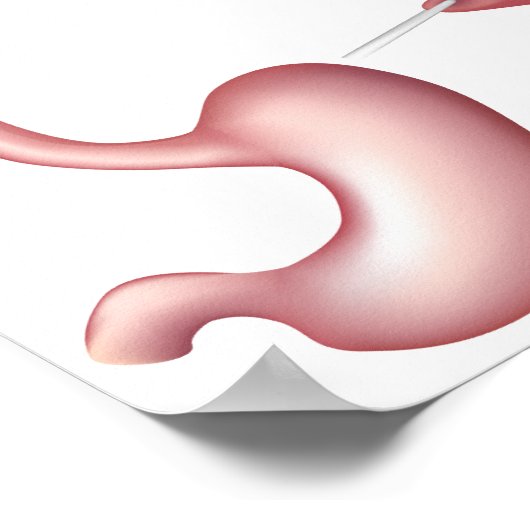 Nissen Fundoplication stomer Operation Poster (Ecke)