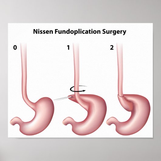 Nissen Fundoplication stomer Operation Poster (Vorne)