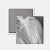 Normale Schulter. Röntgenaufnahme der gesunden lin Magnet (Vorderseite/Rückseite)