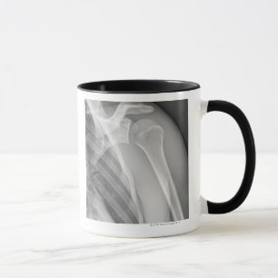 Normale Schulter. Röntgenbild der gesunden linken Tasse