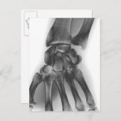 Normales Handgelenk, Röntgenaufnahme Postkarte (Vorne/Hinten)