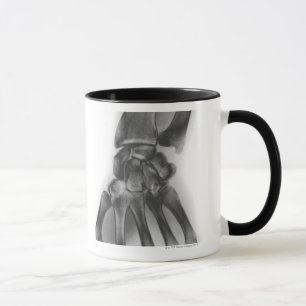 Normales Handgelenk, Röntgenstrahl Tasse