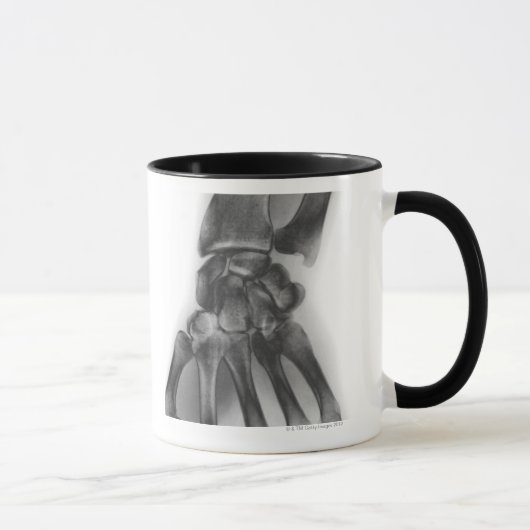 Normales Handgelenk, Röntgenstrahl Tasse (Rechts)