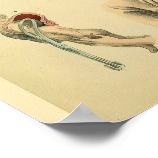 Oberschenkelmuskeln Birth Forceps Anatomie Art Pri Poster (Ecke)