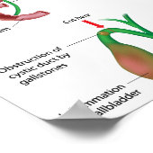 Operation Poster zur Entfernung der Gallenblase (Ecke)