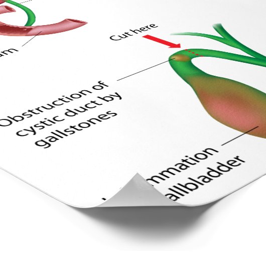 Operation Poster zur Entfernung der Gallenblase (Ecke)