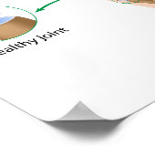 Osteoarthritis der Hand Poster (Ecke)