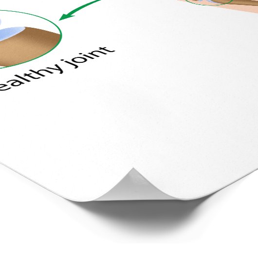 Osteoarthritis der Hand Poster (Ecke)