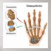 Osteoarthritis der Hand Poster (Vorne)