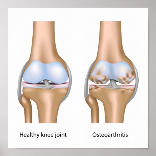 Osteoarthritis Kniegelenk-Poster Poster (Vorne)