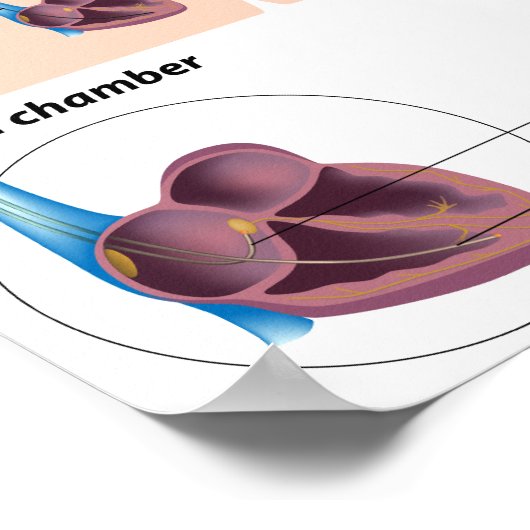 Pacemaker Insertion Operation Poster (Ecke)