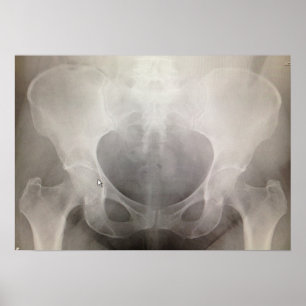 Pelvis-Röntgenstrahl Poster