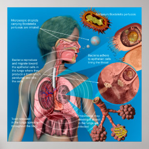 Pertussis (husten)-Poster Poster
