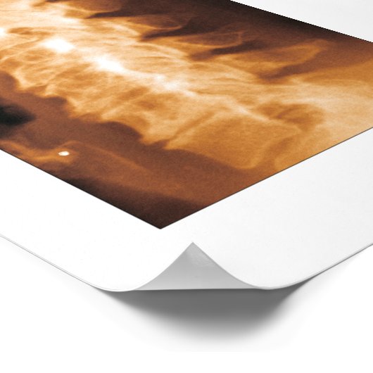 Phasen Zervikale Spinale Degenerationspopster Poster (Ecke)