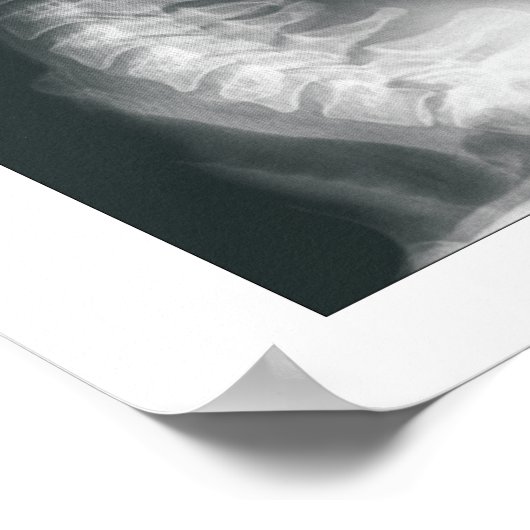 Phasen Zervikale Spinale Degenerationspopster Poster (Ecke)