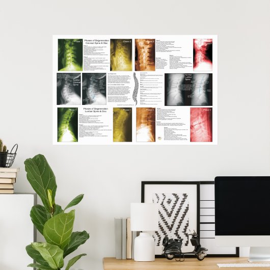 Phasen Zervikales Lumbar Spinal Degenerations Post Poster (Heimbüro)