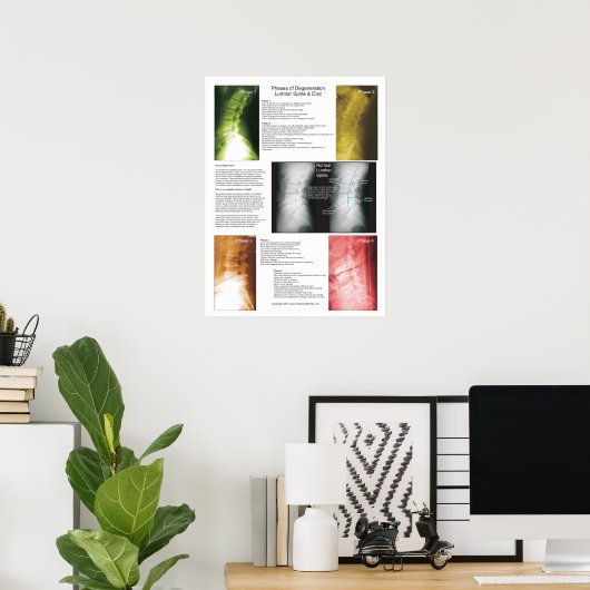 Phases Lumbar Spinal Degenerations Poster (Heimbüro)
