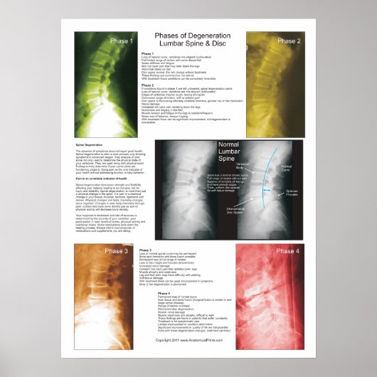 Phases Lumbar Spinal Degenerations Poster (Vorne)