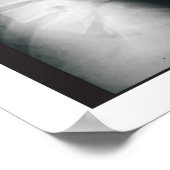 Phases Lumbar Spinal Degenerations Poster (Ecke)