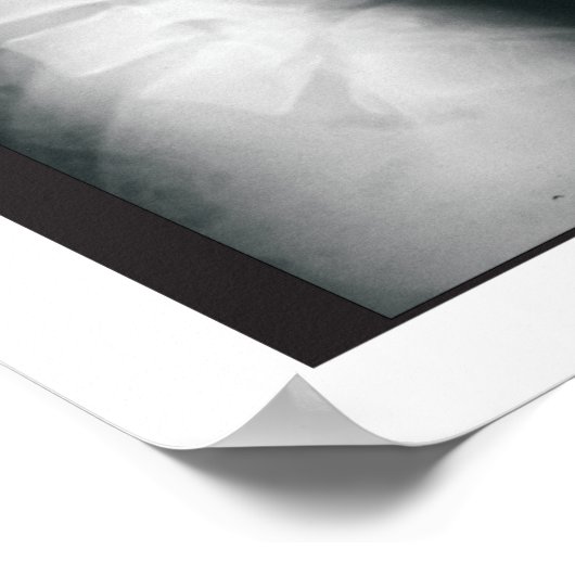 Phases Lumbar Spinal Degenerations Poster (Ecke)