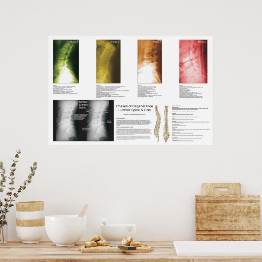 Phases Lumbar Spinal Degenerations Poster (Küche)