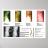 Phases Lumbar Spinal Degenerations Poster (Vorne)