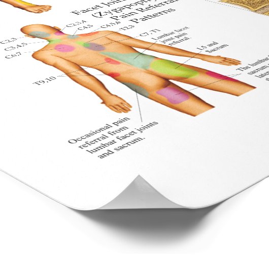 Plakat für visuelle Schmerzen bei Sklerotome (Ecke)