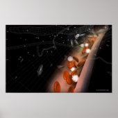 Plaque in den Arterien Poster (Vorne)