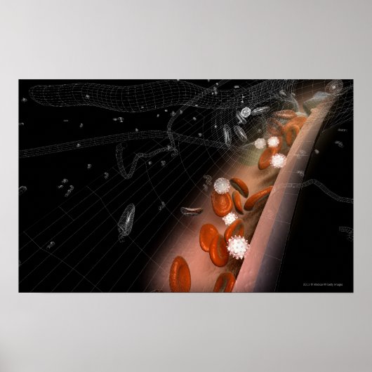 Plaque in den Arterien Poster (Vorne)