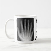 Polydactyl Handröntgenstrahl Kaffeetasse (Links)