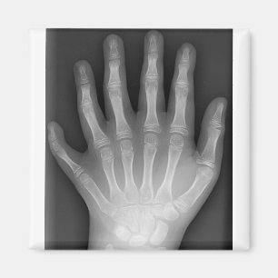Polydaktylie, sechs fingrige Hand, Röntgenstrahl, Magnet