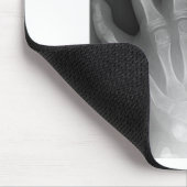 Polydaktylie, sechs fingrige Hand, Röntgenstrahl, Mousepad (Ecke)
