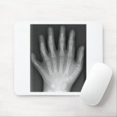 Polydaktylie, sechs fingrige Hand, Röntgenstrahl, Mousepad (Mit Mouse)