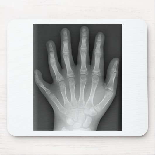 Polydaktylie, sechs fingrige Hand, Röntgenstrahl, Mousepad (Vorne)