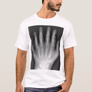 Polydaktylie, sechs fingrige Hand, Röntgenstrahl, T-Shirt