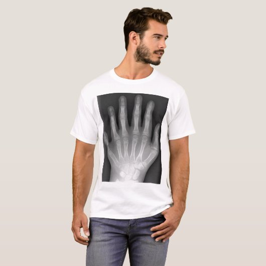 Polydaktylie, sechs fingrige Hand, Röntgenstrahl, T-Shirt (Vorne ganz)