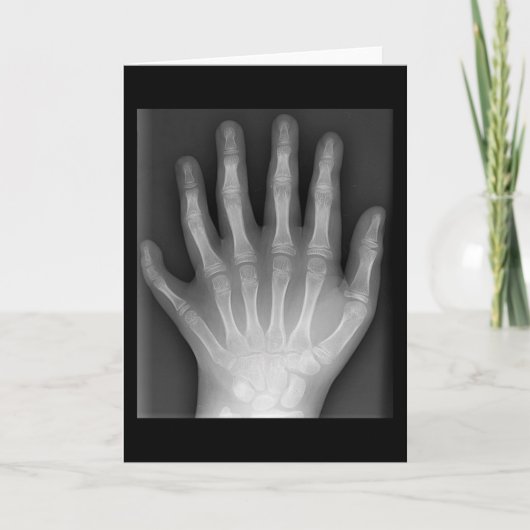 Polydaktylie, Sechs gefederte Hand, X-Ray, Seltenh Karte (Vorderseite)