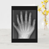 Polydaktylie, Sechs gefederte Hand, X-Ray, Seltenh Karte (Gelbe Blume)