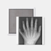 Polydaktylie, Sechs gefederte Hand, X-Ray, Seltenh Magnet (Vorderseite/Rückseite)