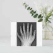 Polydaktylie, Sechs gefederte Hand, X-Ray, Seltenh Postkarte (Stehend Vorderseite)