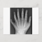 Polydaktylie, Sechs gefederte Hand, X-Ray, Seltenh Postkarte (Vorderseite)